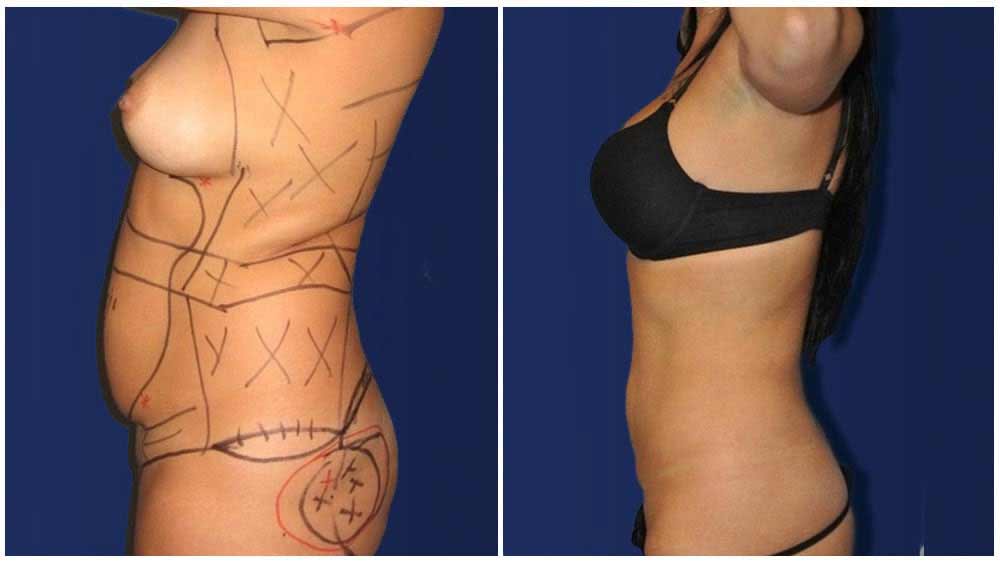 Fat Transfer of a Nashville Liposuction Specialty Clinic Female Patient - (30 years)